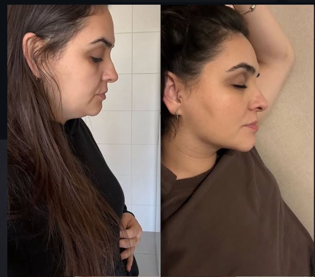 Comparativo de antes e depois de acompanhamento pós-operatório facial
